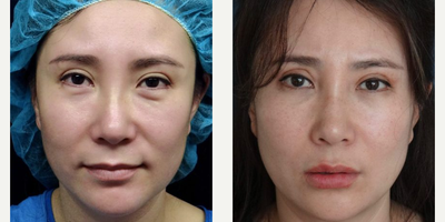 Facelift before and after photo