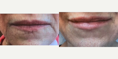 Juvederm before and after photo