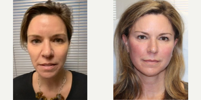 Liquid Facelift before and after photo