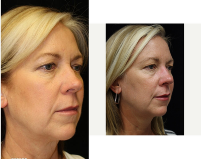 Sculptra before and after photo