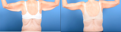 Arm Lift before and after photo