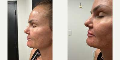 Dermal Fillers before and after photo