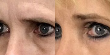 Eyelid Surgery before and after photo