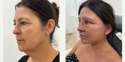 Eyelid Surgery before and after photo
