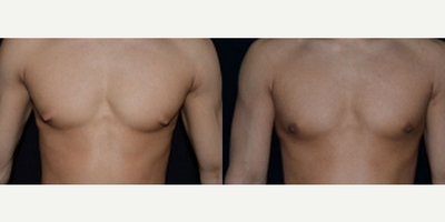 Gynecomastia Surgery before and after photo