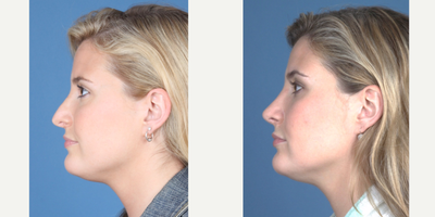 Revision Rhinoplasty before and after photo