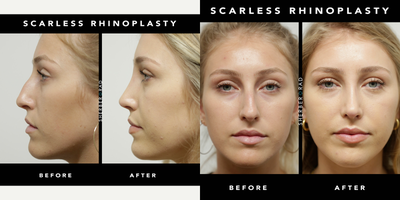 Rhinoplasty before and after photo