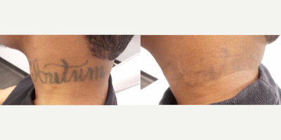 Tattoo Removal before and after photo