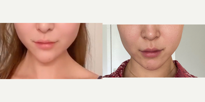 Botox for TMJ before and after photo