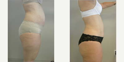 Liposuction before and after photo