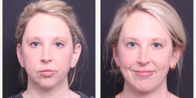 Chin Liposuction before and after photo