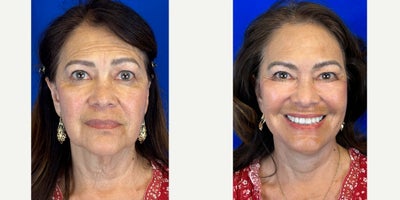 Deep Plane Facelift before and after photo