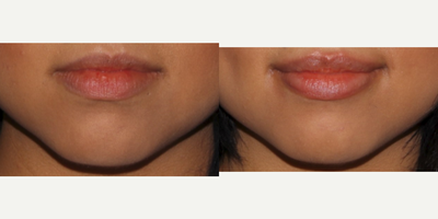Dermal Fillers before and after photo