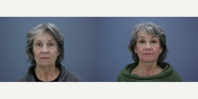 Eyelid Surgery before and after photo