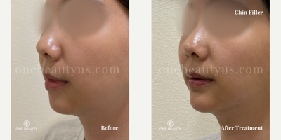 Juvederm before and after photo