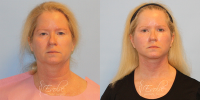 Neck Lift before and after photo