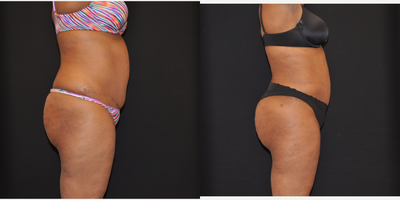 Brazilian Butt Lift before and after photo