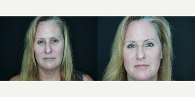 CO2 Laser before and after photo