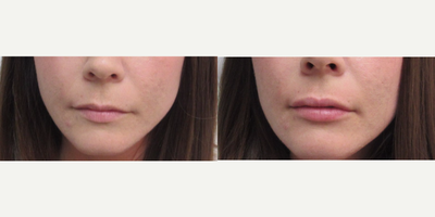 Dermal Fillers before and after photo
