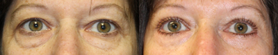 Eyelid Surgery before and after photo