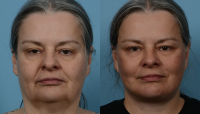 Facelift before and after photo