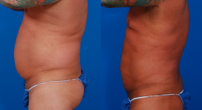 Liposculpture before and after photo