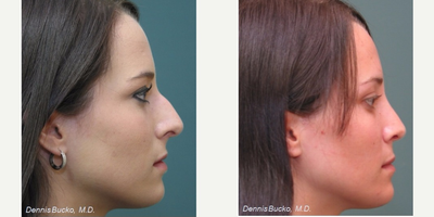 Rhinoplasty before and after photo