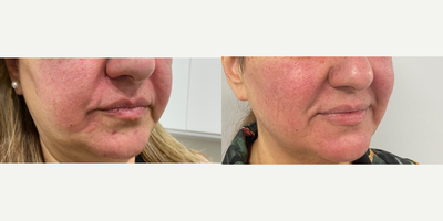 Skin Tightening before and after photo