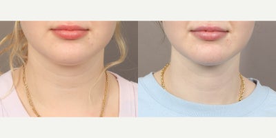 Vaser Liposuction before and after photo