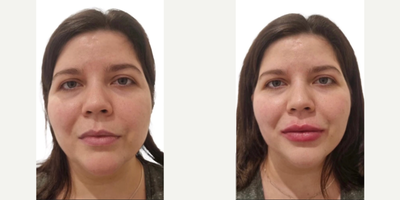 Cheek Fillers before and after photo