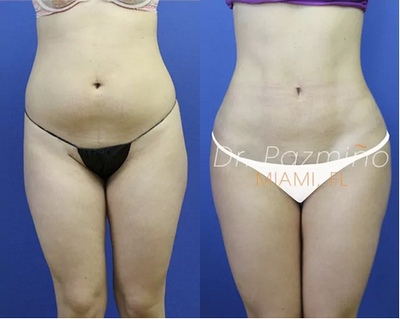 Liposuction before and after photo