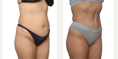 Smart Lipo before and after photo