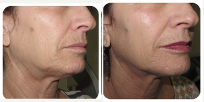 Bellafill before and after photo