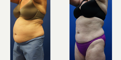 CoolSculpting before and after photo