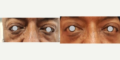 Eyelid Surgery before and after photo