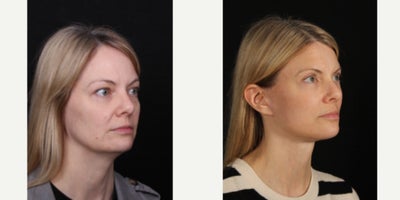 Facelift before and after photo
