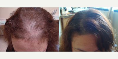 FUE Hair Transplant before and after photo