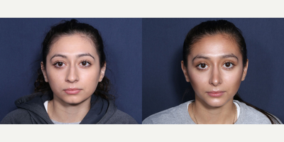 Rhinoplasty before and after photo