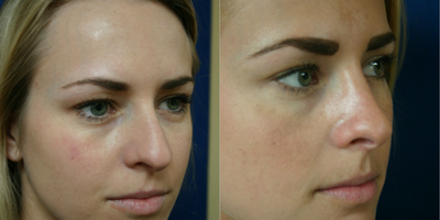 Rhinoplasty before and after photo