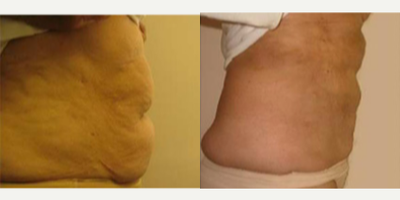 Laser Liposuction before and after photo