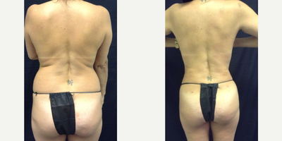 Laser Liposuction before and after photo