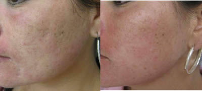 Restylane before and after photo