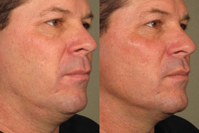 Ultherapy before and after photo