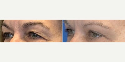 CO2 Laser before and after photo