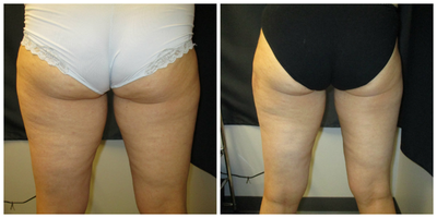 SculpSure before and after photo