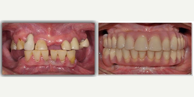 All-on-4 Dental Implants before and after photo