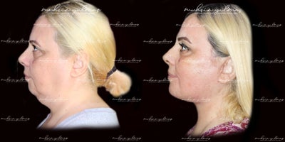 Buccal Fat Removal before and after photo