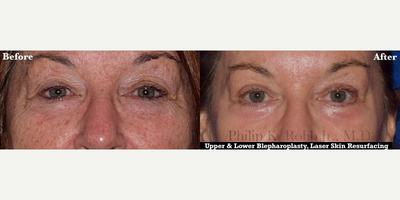Eyelid Surgery before and after photo