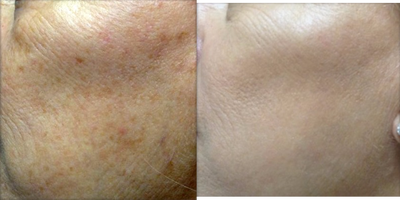 Laser Resurfacing before and after photo