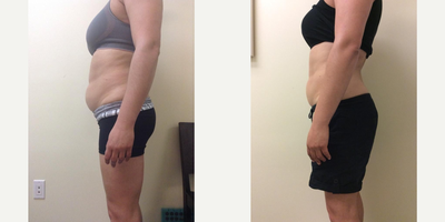 CoolSculpting before and after photo